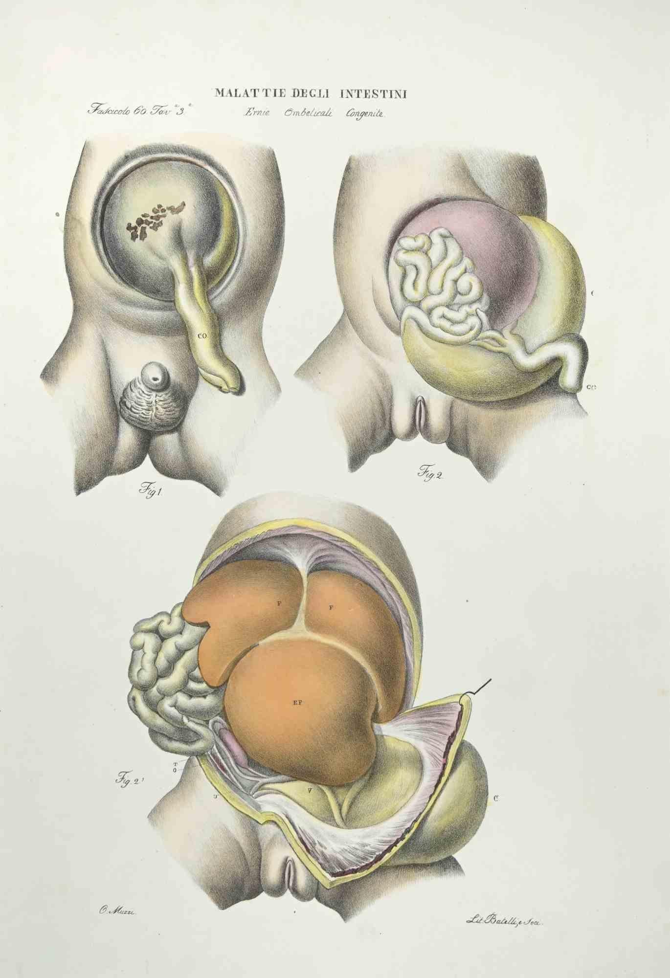 Diseases of the Intestines ist eine handkolorierte Lithographie von Ottavio Muzzi für die Ausgabe von Antoine Chazal, Human Anatomy, Druckerei Batelli und Ridolfi, aus dem Jahr 1843.

Signiert auf der Platte am unteren linken Rand.

Das Kunstwerk