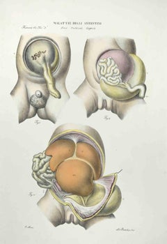 diseases of the Intestines – Lithographie von Ottavio Muzzi, „Krankheiten der Testine“ – 1843