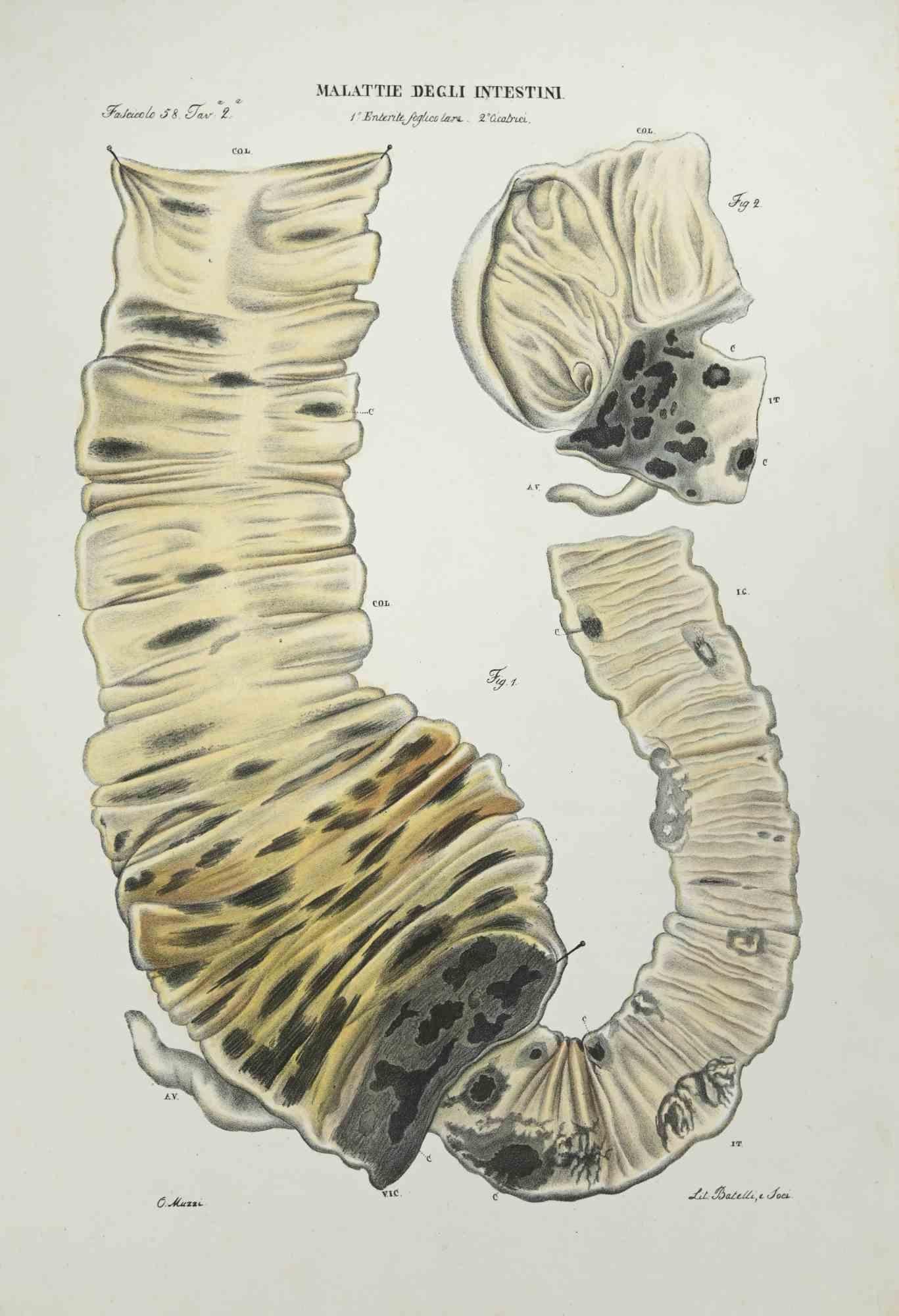 Malattie dell'intestino è una litografia colorata a mano da Ottavio Muzzi per l'edizione di Antoine Chazal, Anatomia umana, tipografia Batelli e Ridolfi, realizzata nel 1843.

Firmato sulla lastra nel margine inferiore sinistro.

L'opera appartiene