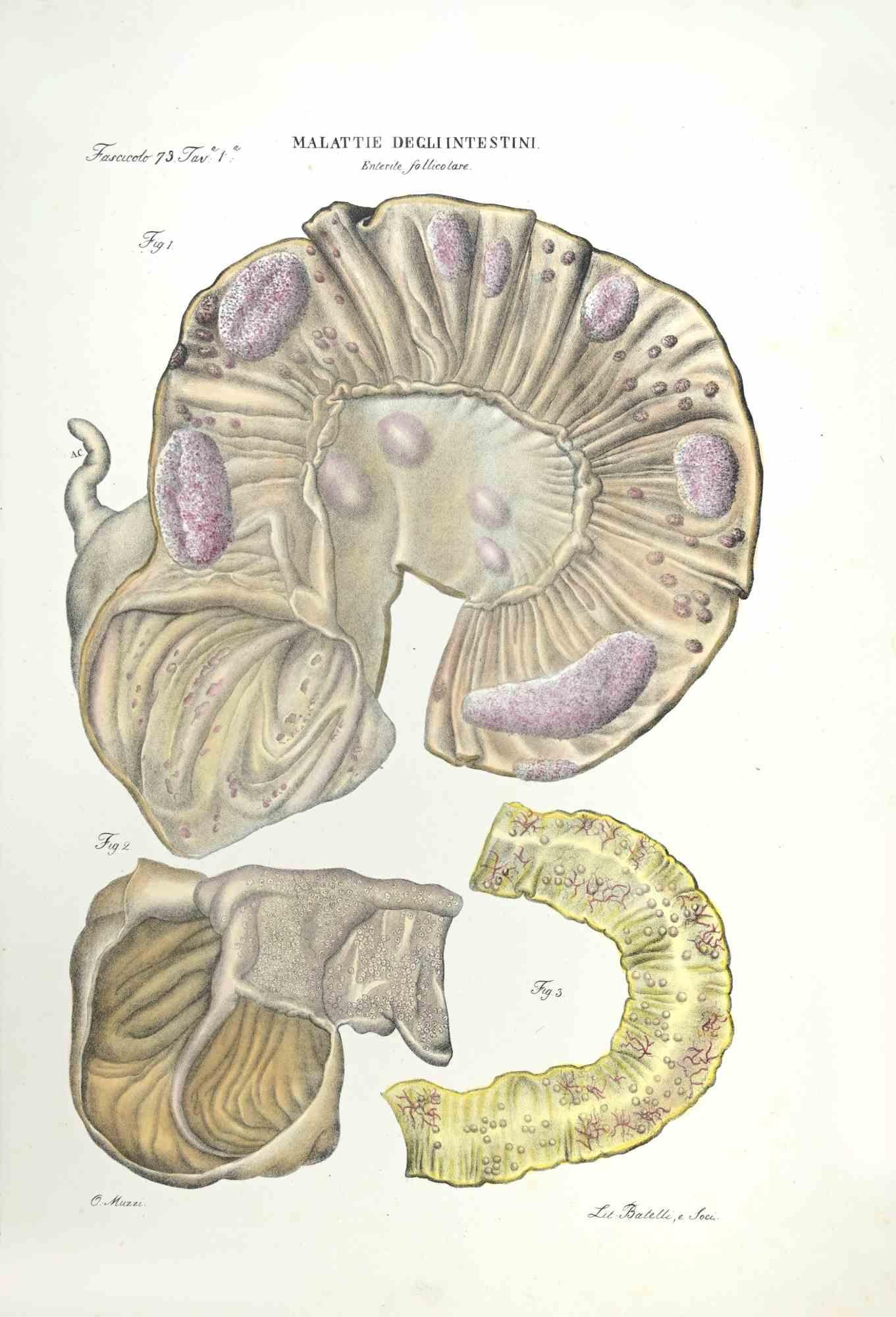Malattie dell'intestino  è una litografia colorata a mano da Ottavio Muzzi per l'edizione di Antoine Chazal, Anatomia umana, tipografia Batelli e Ridolfi, realizzata nel 1843.

Firmato sulla lastra nel margine inferiore sinistro.

L'opera appartiene