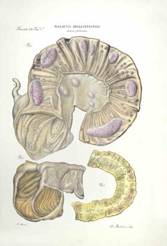 Diseases of the Intestines   - Lithograph By Ottavio Muzzi - 1843