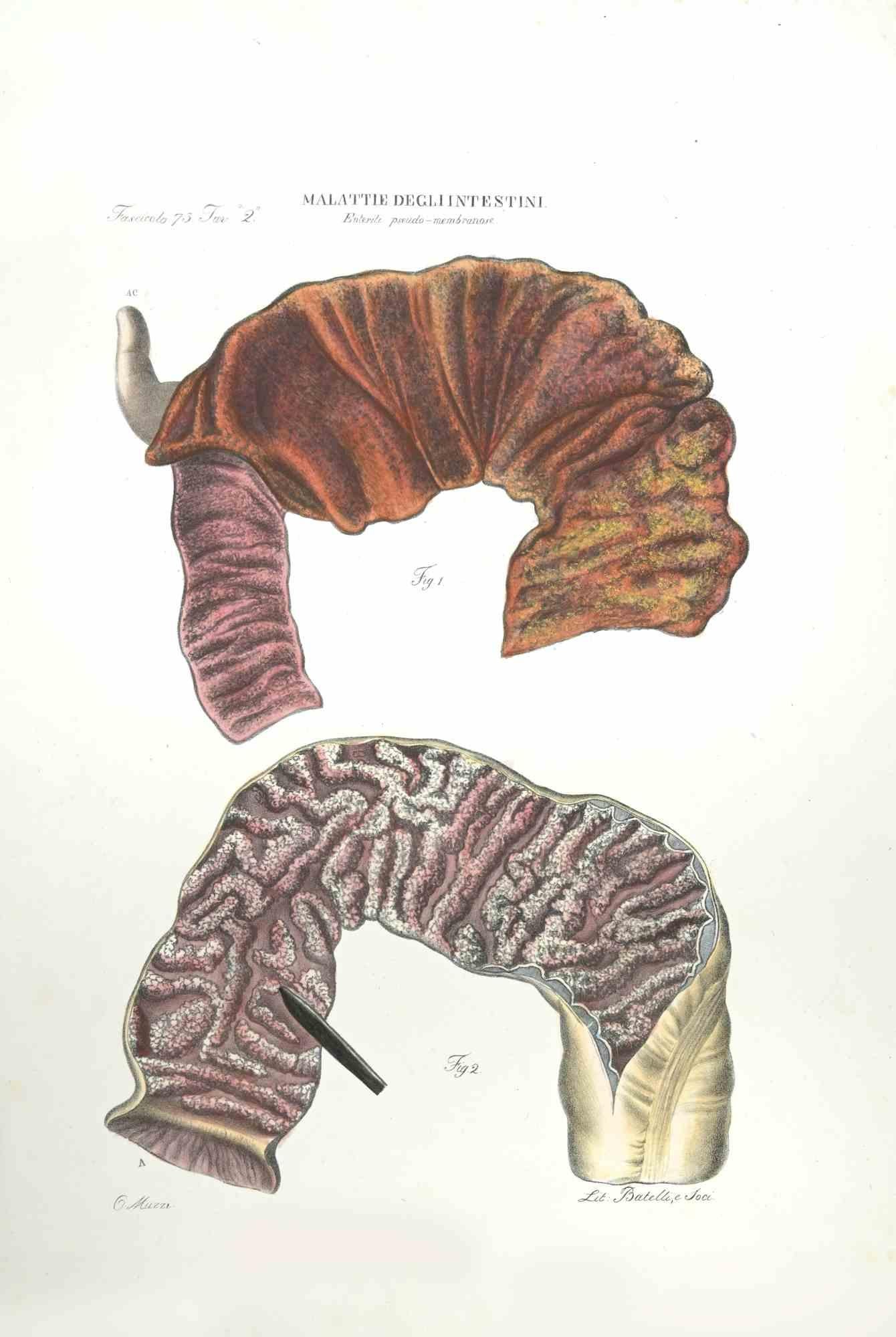 Diseases of the Intestines  is a lithograph hand colored by Ottavio Muzzi for the edition of Antoine Chazal,Human Anatomy, Printers Batelli and Ridolfi, realized in 1843.

Signed on plate on the lower left margin.

The artwork belongs to the
