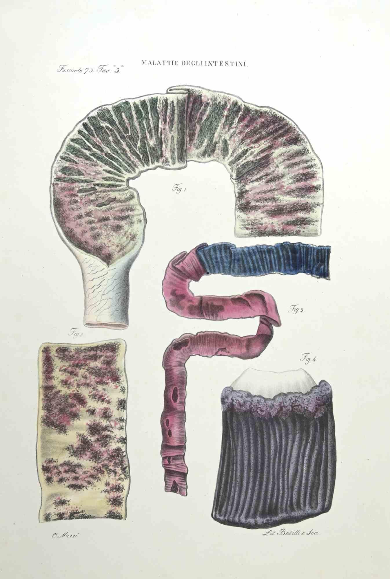 Diseases of the Intestines  is a lithograph hand colored by Ottavio Muzzi for the edition of Antoine Chazal,Human Anatomy, Printers Batelli and Ridolfi, realized in 1843.

Signed on plate on the lower left margin.

The artwork belongs to the