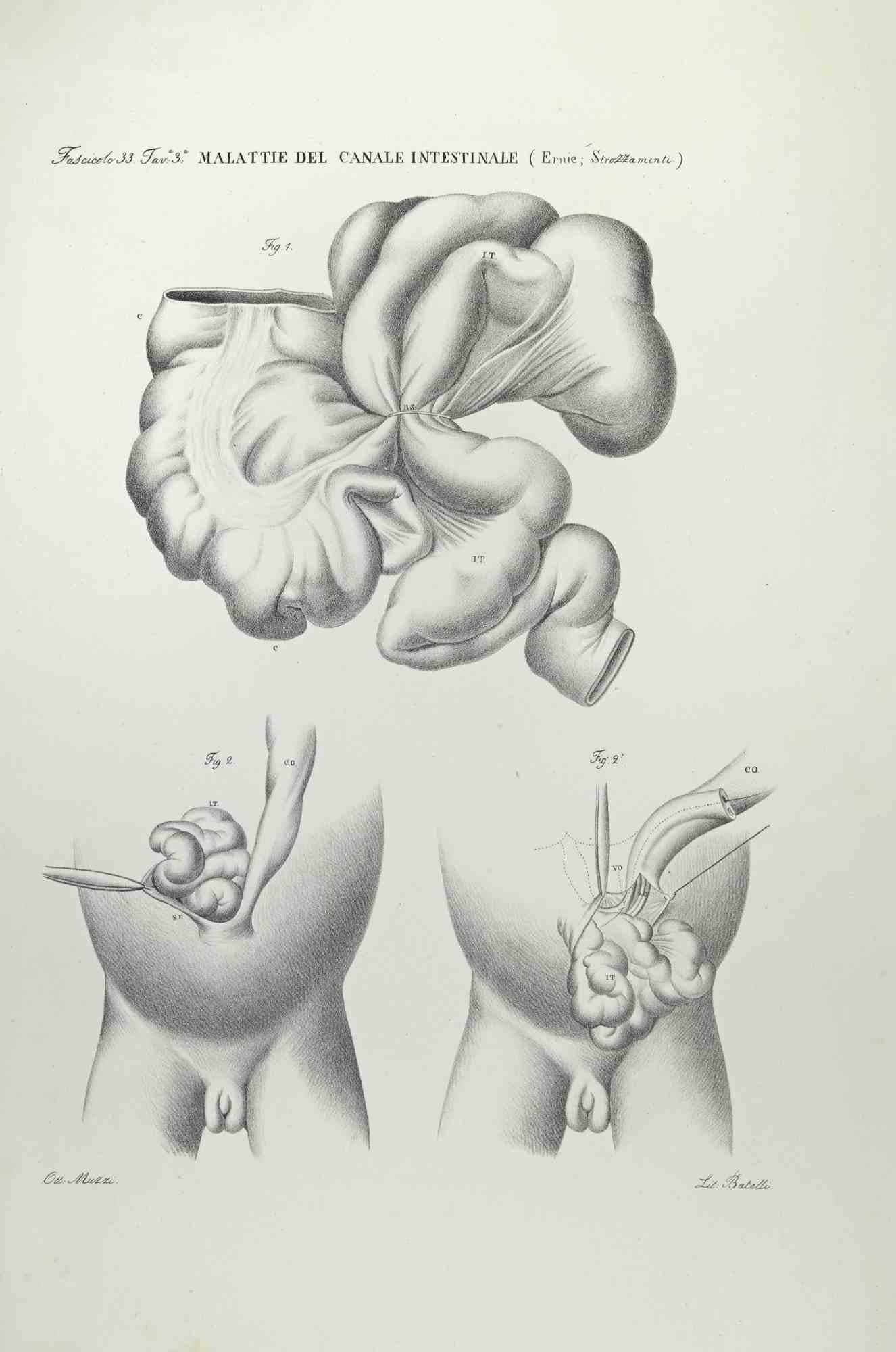 Diseases of the Intestines ist eine handkolorierte Lithographie von Ottavio Muzzi für die Ausgabe von Antoine Chazal, Human Anatomy, Druckerei Batelli und Ridolfi, aus dem Jahr 1843.

Signiert auf der Platte am unteren linken Rand.


