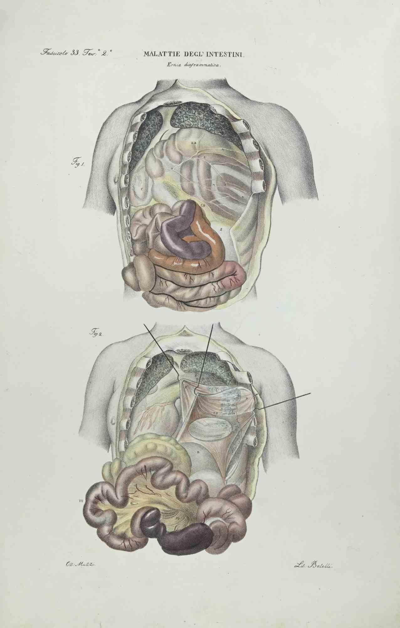Diseases of the Intestines  is a lithograph hand colored by Ottavio Muzzi for the edition of Antoine Chazal,Human Anatomy, Printers Batelli and Ridolfi, realized in 1843.

Signed on plate on the lower left margin.


