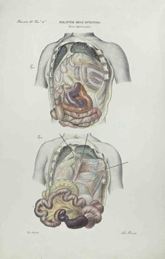 Antique Diseases of the Intestines  - Lithograph By Ottavio Muzzi - 1843