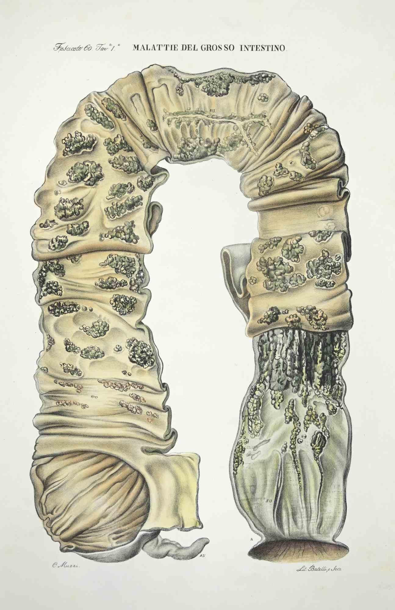 Diseases of the Large Intestine is a lithograph hand colored by Ottavio Muzzi for the edition of Antoine Chazal,Human Anatomy, Printers Batelli and Ridolfi, realized in 1843.

Signed on plate on the lower left margin.

The artwork belongs to the
