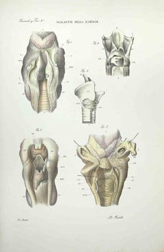 Diseases of the Laringe - Lithograph By Ottavio Muzzi - 1843