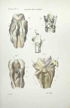 Malattie del Laringe - Litografia di Ottavio Muzzi - 1843