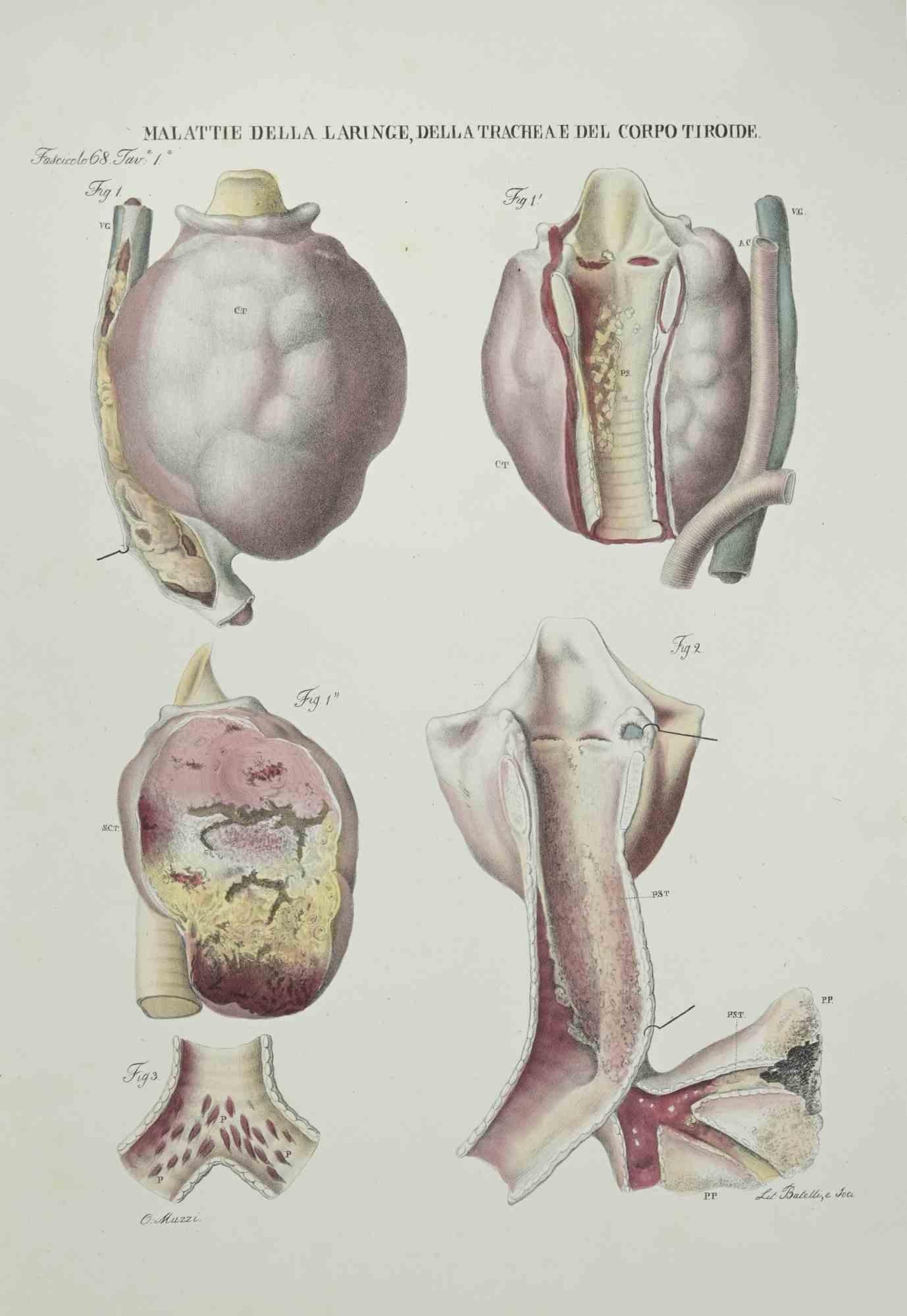 Diseases of the Larynx, Trachea and Thyroid Body is a lithograph hand colored by Ottavio Muzzi for the edition of Antoine Chazal,Human Anatomy, Printers Batelli and Ridolfi, realized in 1843.

Signed on plate on the lower left margin.

The artwork