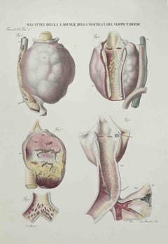 Diseases of the Larynx, Trachea and Thyroid - Lithograph By Ottavio Muzzi - 1843