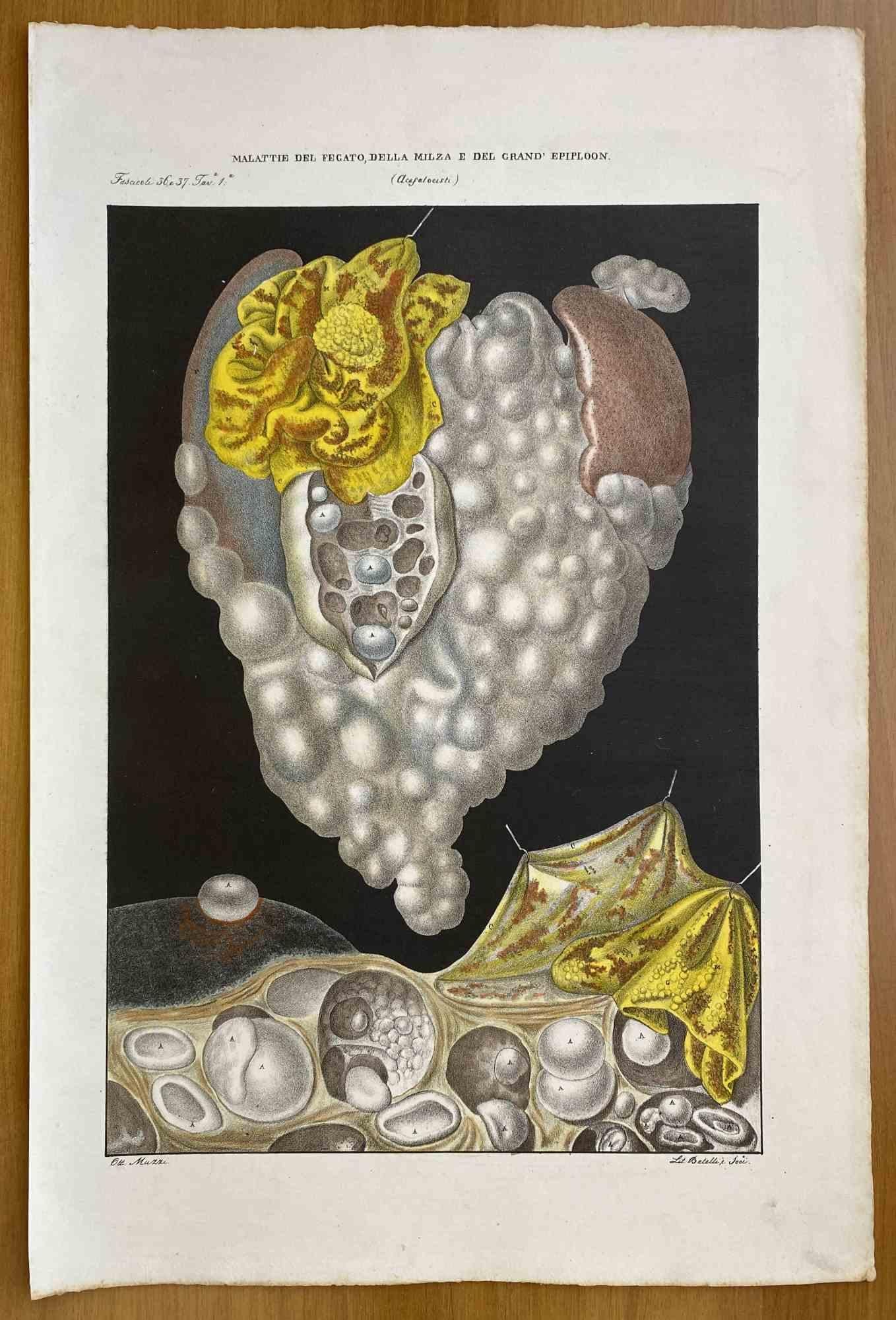 Enfermedades del Hígado, Bazo y Epiploon es una litografía coloreada a mano por Ottavio Muzzi para la edición de Antoine Chazal, Anatomía Humana, Imprenta Batelli y Ridolfi, 1843.

La obra pertenece al Atlante generale della anatomia patologica del