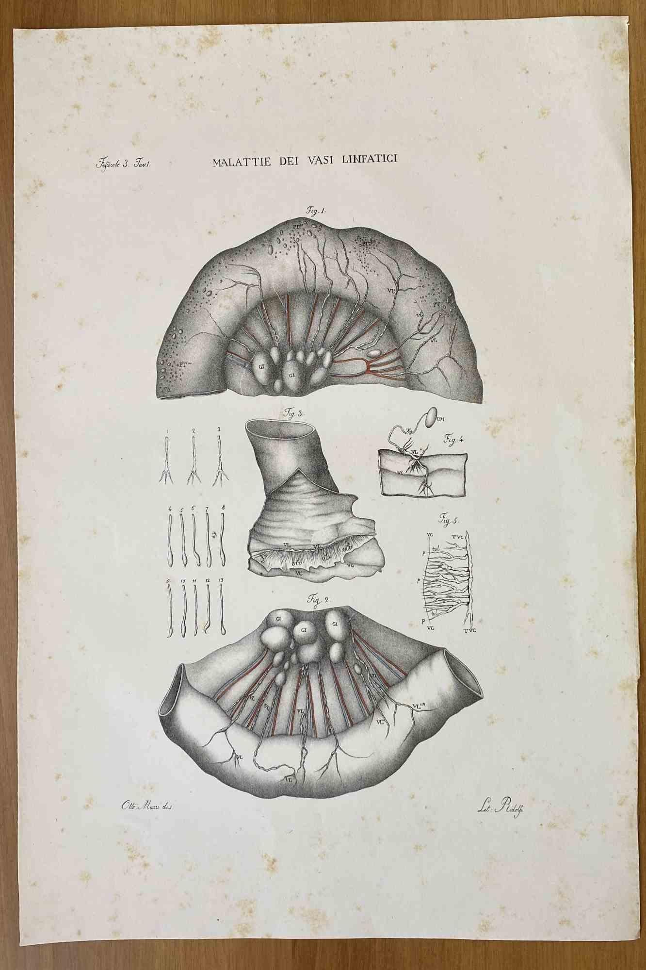 Diseases of the Lymphatic Vessels is a lithograph hand colored by Ottavio Muzzi for the edition of Antoine Chazal, Human Anatomy, Printers Batelli and Ridolfi, 1843.

The work belongs to the Atlante generale della anatomia patologica del corpo umano