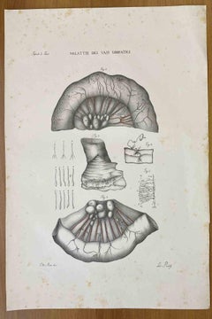 Diseases of the Lymphatic Vessels - Lithograph By Ottavio Muzzi - 1843