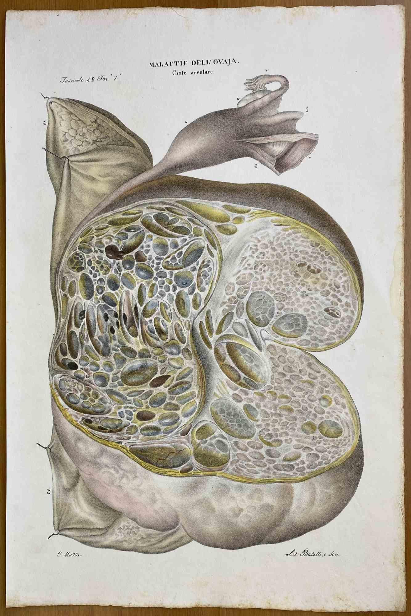 Enfermedades del Ovario es una litografía coloreada a mano por Ottavio Muzzi para la edición de Antoine Chazal, Anatomía Humana, Imprenta Batelli y Ridolfi, 1843.

La obra pertenece al Atlante generale della anatomia patologica del corpo umano de