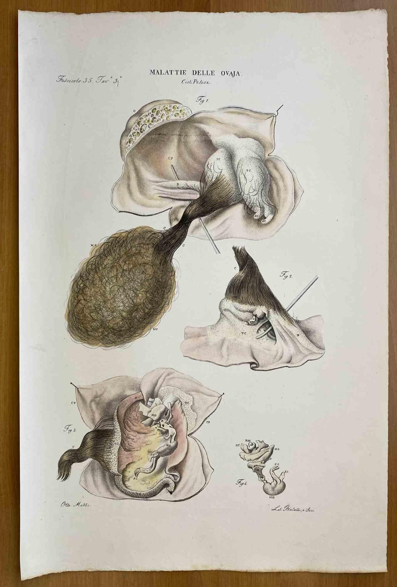 Diseases of the Ovary is a lithograph hand colored by Ottavio Muzzi for the edition of Antoine Chazal, Human Anatomy, Printers Batelli and Ridolfi, 1843.

The work belongs to the Atlante generale della anatomia patologica del corpo umano by Jean