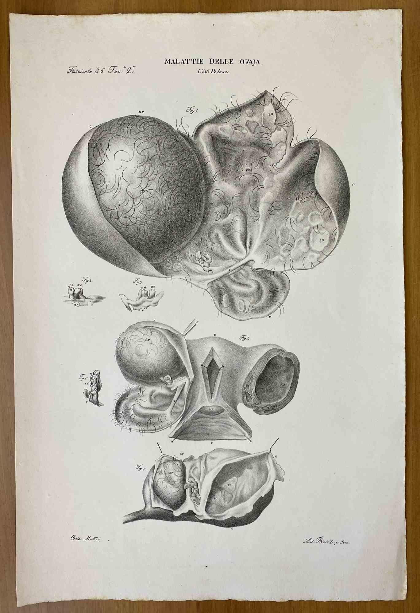 Enfermedades del Ovario - Litografía de Ottavio Muzzi - 1843