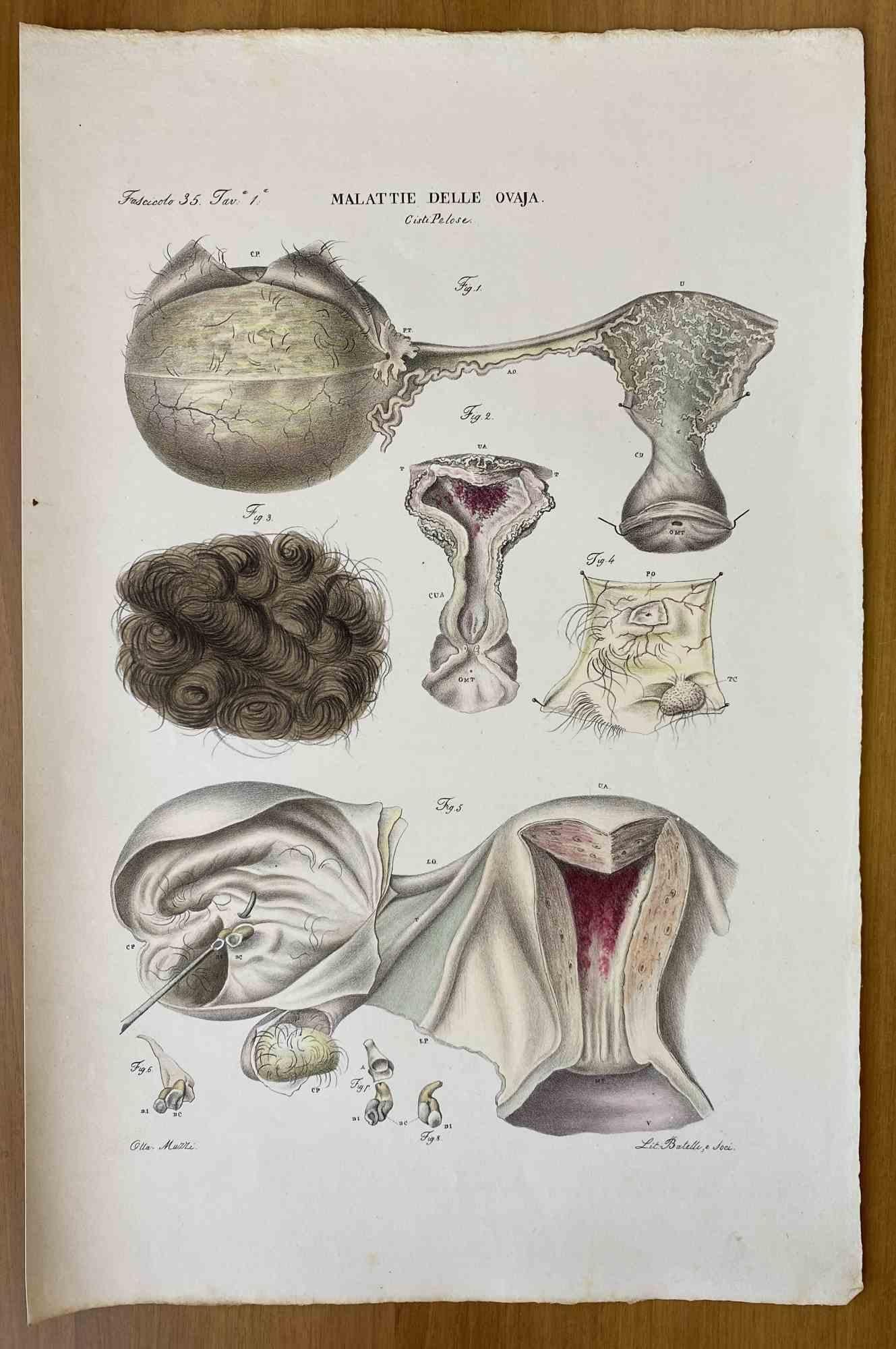 Diseases of the Ovary is a lithograph hand colored by Ottavio Muzzi for the edition of Antoine Chazal, Human Anatomy, Printers Batelli and Ridolfi, 1843.

The work belongs to the Atlante generale della anatomia patologica del corpo umano by Jean