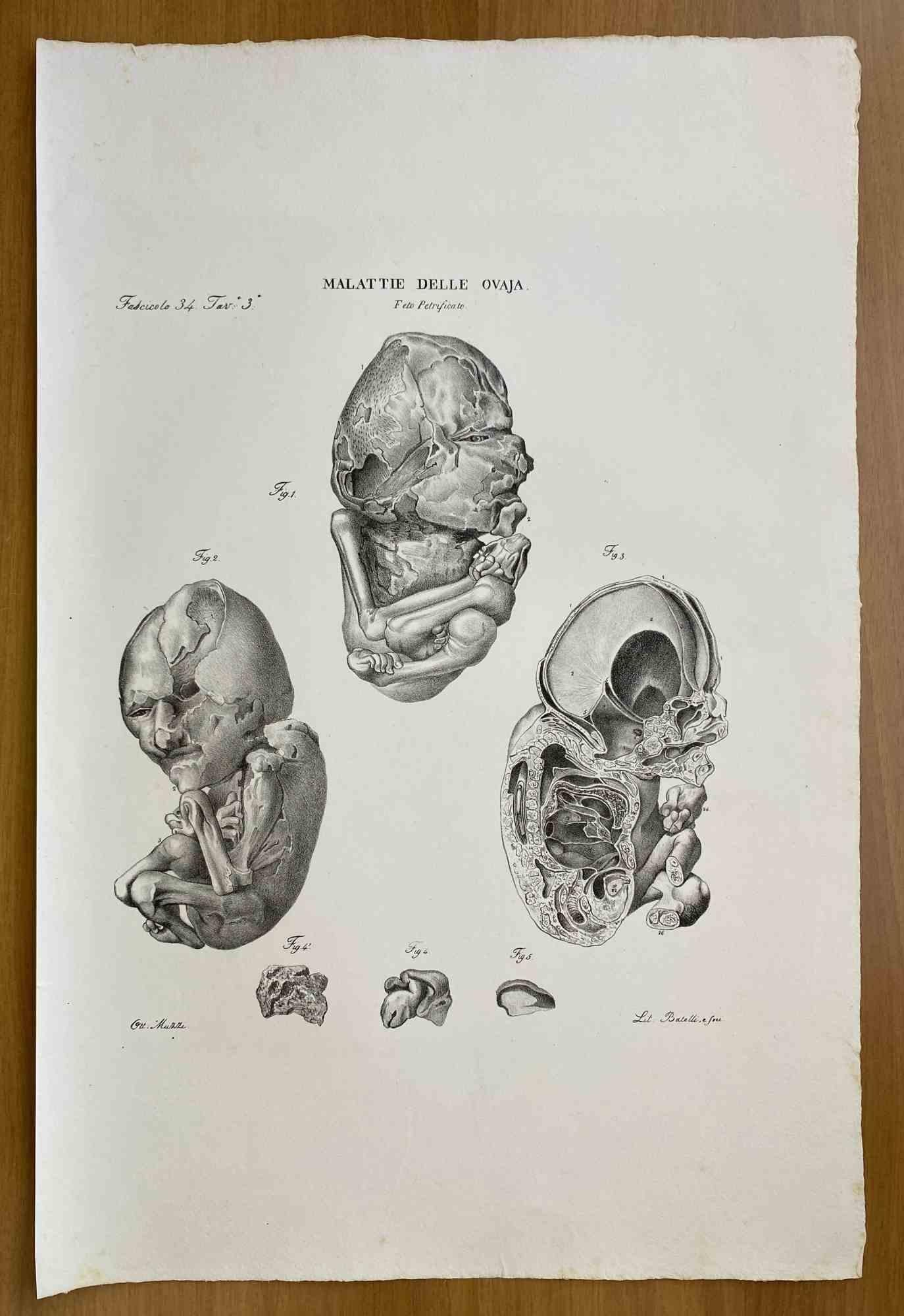 Diseases of the Ovary is a lithograph hand colored by Ottavio Muzzi for the edition of Antoine Chazal, Human Anatomy, Printers Batelli and Ridolfi, 1843.

The work belongs to the Atlante generale della anatomia patologica del corpo umano by Jean