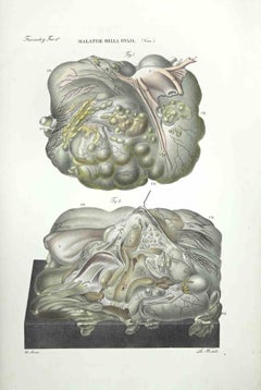 Diseases of the Ovary - Lithograph By Ottavio Muzzi - 1843