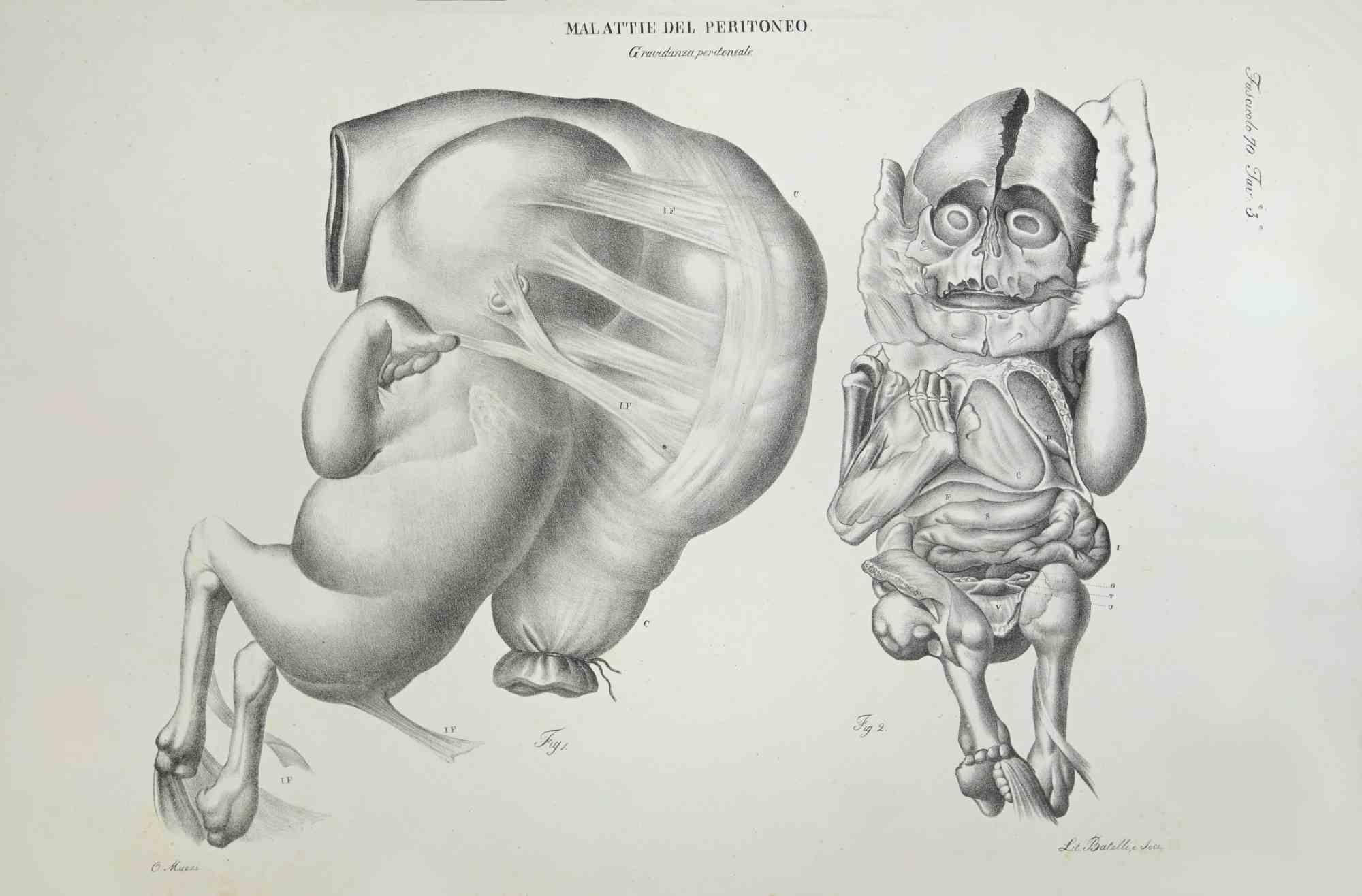 Diseases of the Peritoneum ist eine handkolorierte Lithographie von Ottavio Muzzi für die Ausgabe von Antoine Chazal, Human Anatomy, Druckerei Batelli und Ridolfi, aus dem Jahr 1843.

Signiert auf der Platte am unteren linken Rand.

Das Kunstwerk