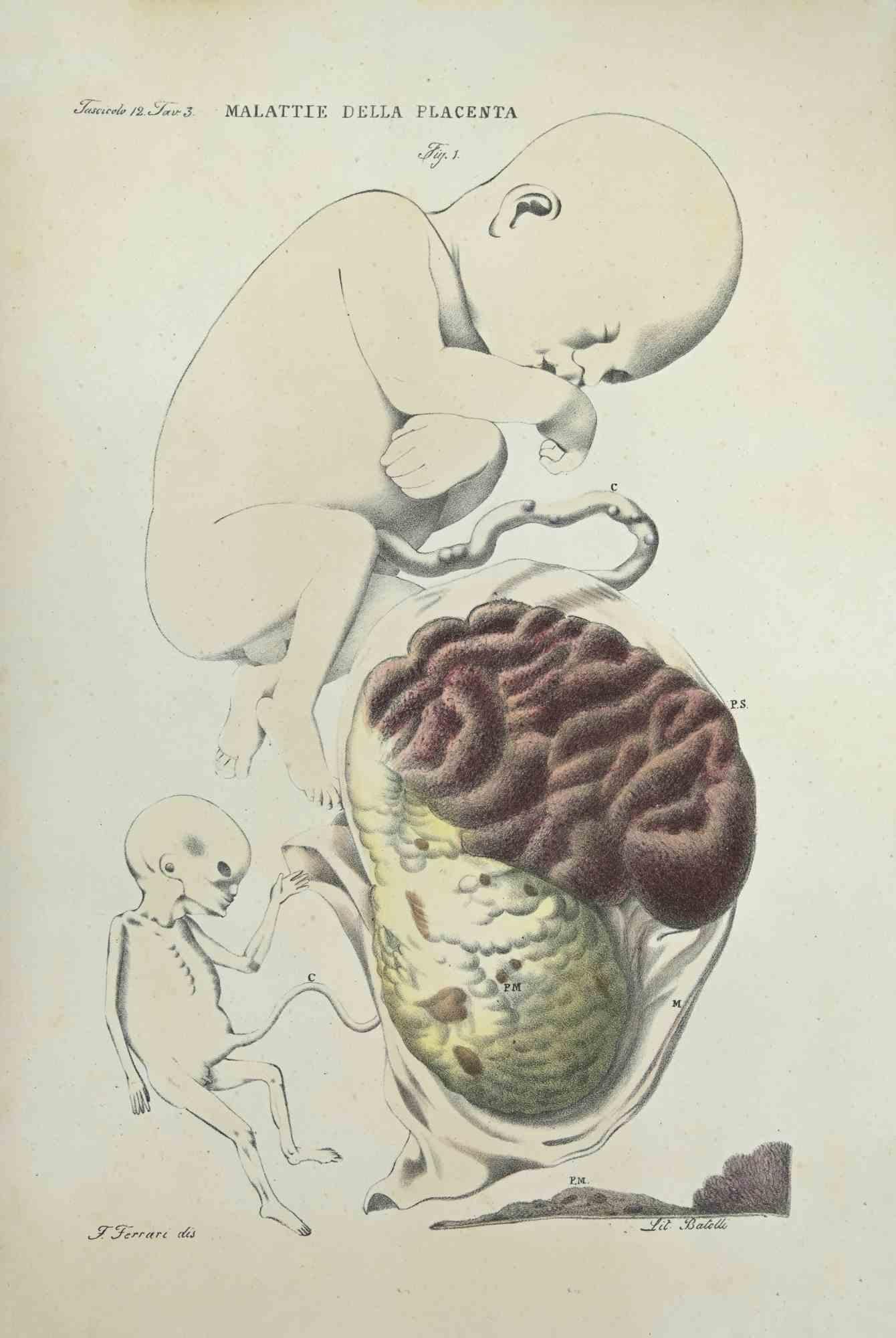Diseases of the Plannta is a lithograph hand colored by Ottavio Muzzi for the edition of Antoine Chazal, Human Anatomy, Printers Batelli and Ridolfi, 1843.

The work belongs to the Atlante generale della anatomia patologica del corpo umano by Jean