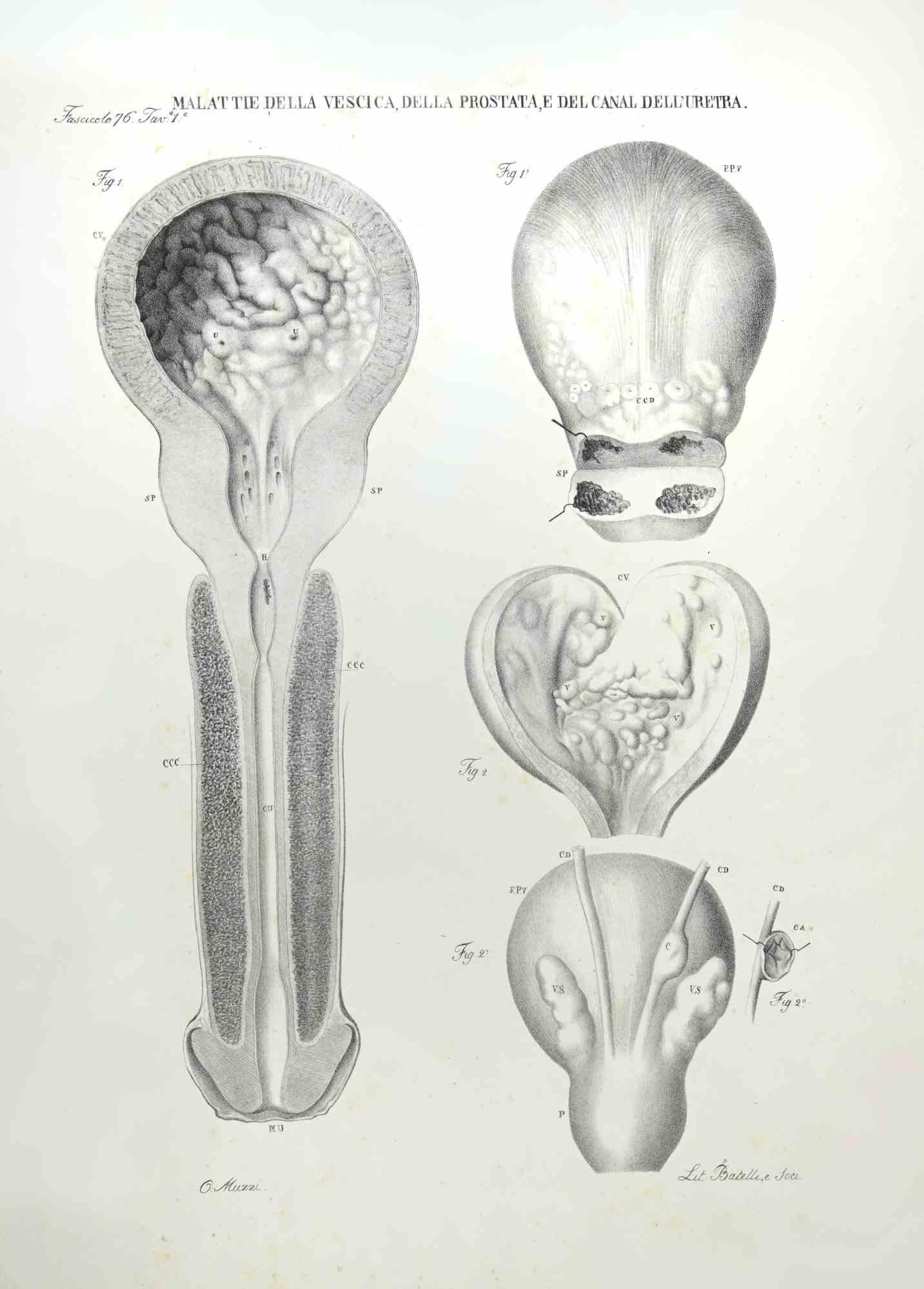 Diseases of the Prostate and the Urethra Canal ist eine handkolorierte Lithographie von Ottavio Muzzi für die Ausgabe von Antoine Chazal, Human Anatomy, Printers Batelli and Ridolfi, realisiert 1843.

Signiert auf der Platte am unteren linken