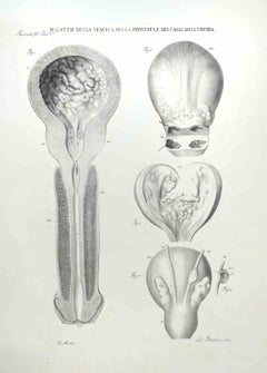 diseases of the Prostate and the Urethra  - Lithographie von Ottavio Muzzi - 1843