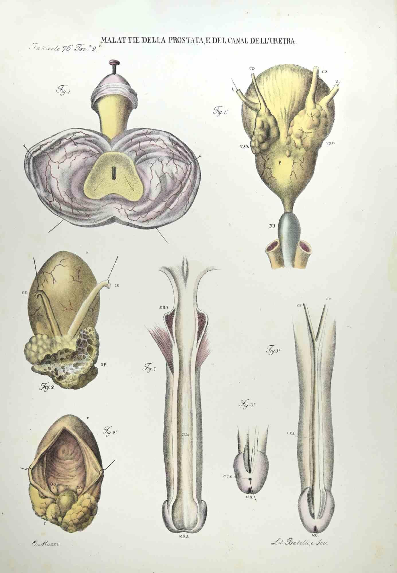 Maladies de la prostate et du canal de l'urètre est une lithographie coloriée à la main par Ottavio Muzzi pour l'édition d'Antoine Chazal, Anatomie humaine, Imprimeurs Batelli et Ridolfi, réalisée en 1843.

Signé sur la plaque dans la marge