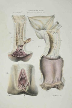 Diseases of the Rectum - Lithograph By Ottavio Muzzi - 1843