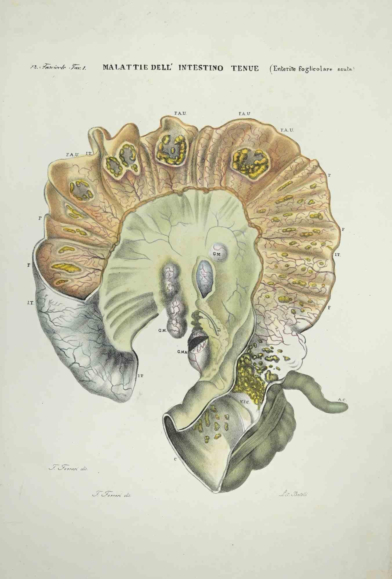 Maladies de l'intestin grêle - Lithographie d'Ottavio Muzzi - 1843