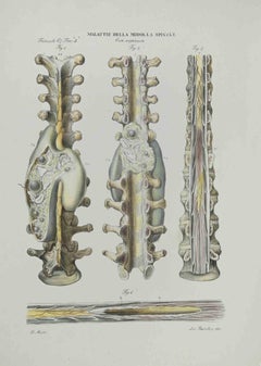 Diseases of the Spinal Cord - Lithograph By Ottavio Muzzi - 1843