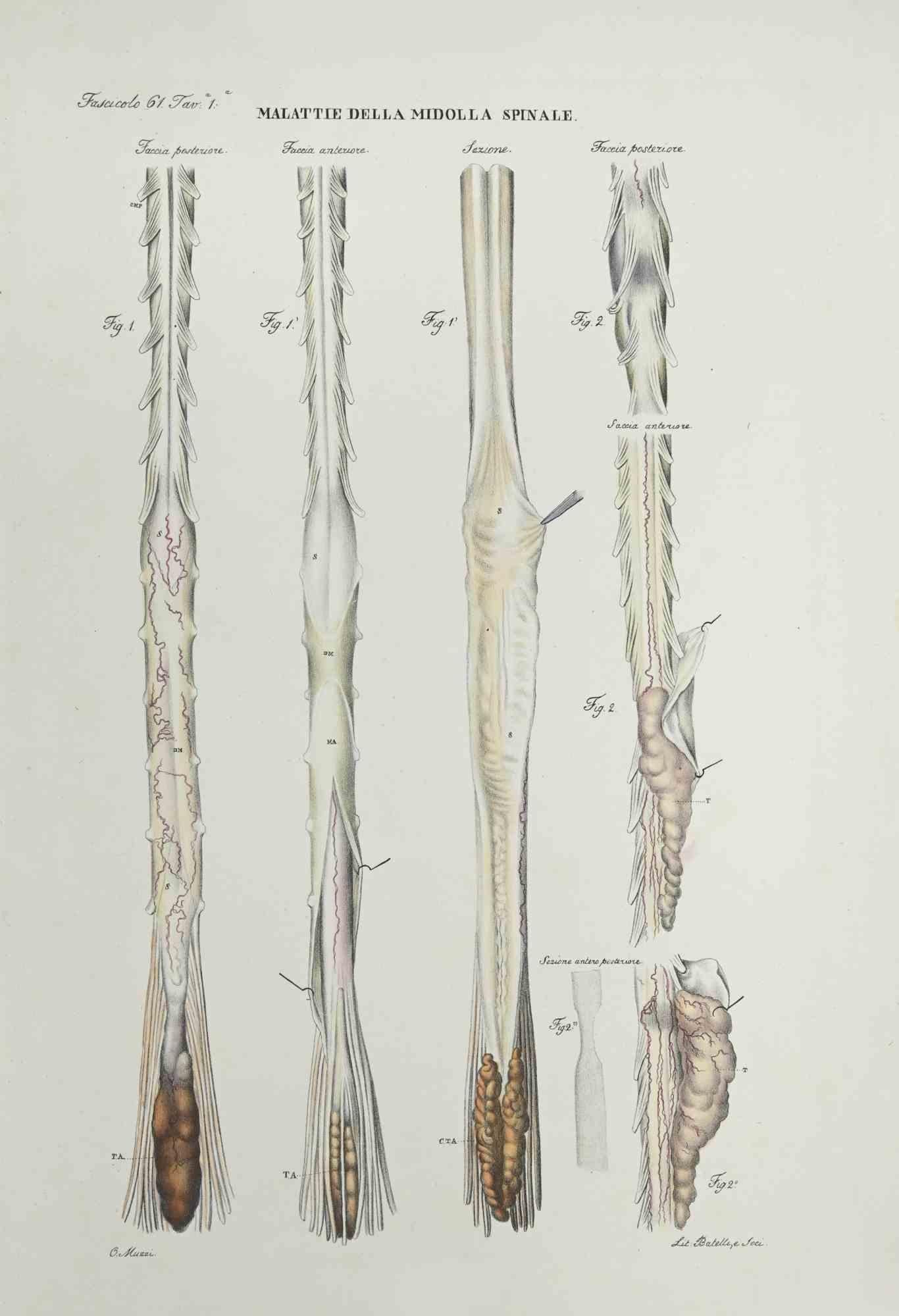 Diseases of the Spinal Cord is a lithograph hand colored by Ottavio Muzzi for the edition of Antoine Chazal,Human Anatomy, Printers Batelli and Ridolfi, realized in 1843.

Signed on plate on the lower left margin.

The artwork belongs to the