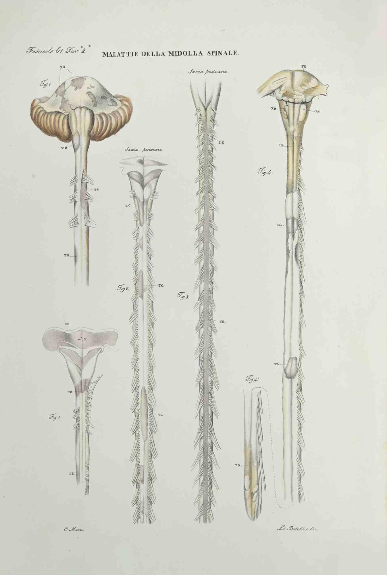 Diseases of the Spinal Cord ist eine handkolorierte Lithographie von Ottavio Muzzi für die Ausgabe von Antoine Chazal, Human Anatomy, Druckerei Batelli und Ridolfi, aus dem Jahr 1843.

Signiert auf der Platte am unteren linken Rand.

Das Kunstwerk