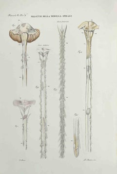 diseases of the Spinal Cord – Lithographie von Ottavio Muzzi – 1843