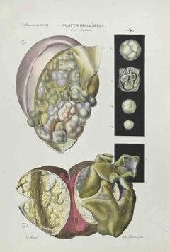 Diseases of the Spleen - Lithograph By Ottavio Muzzi - 1843