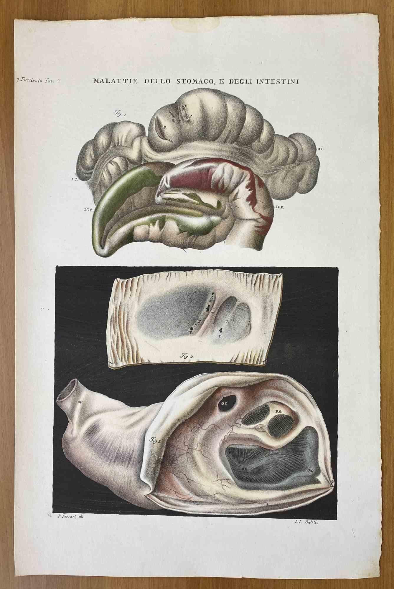 Diseases of the Stomach and Intestines is a lithograph hand colored by Ottavio Muzzi for the edition of Antoine Chazal, Human Anatomy, Printers Batelli and Ridolfi, 1843.

The work belongs to the Atlante generale della anatomia patologica del corpo