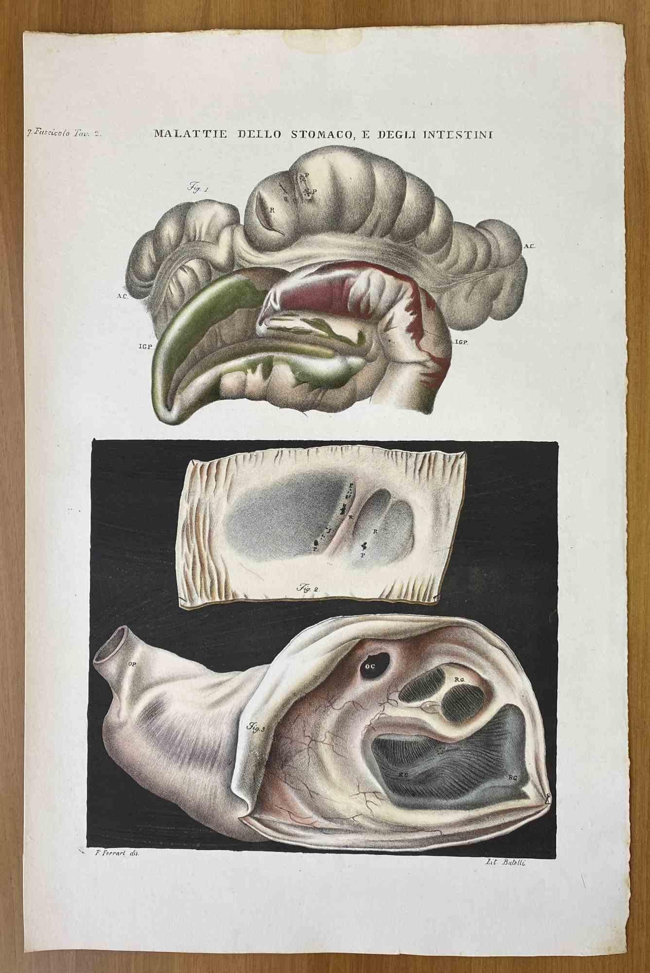 Enfermedades del estómago y de los intestinos es una litografía coloreada a mano por Ottavio Muzzi para la edición de Antoine Chazal, Anatomía humana, Imprenta Batelli y Ridolfi, 1843.

La obra pertenece al Atlante generale della anatomia patologica