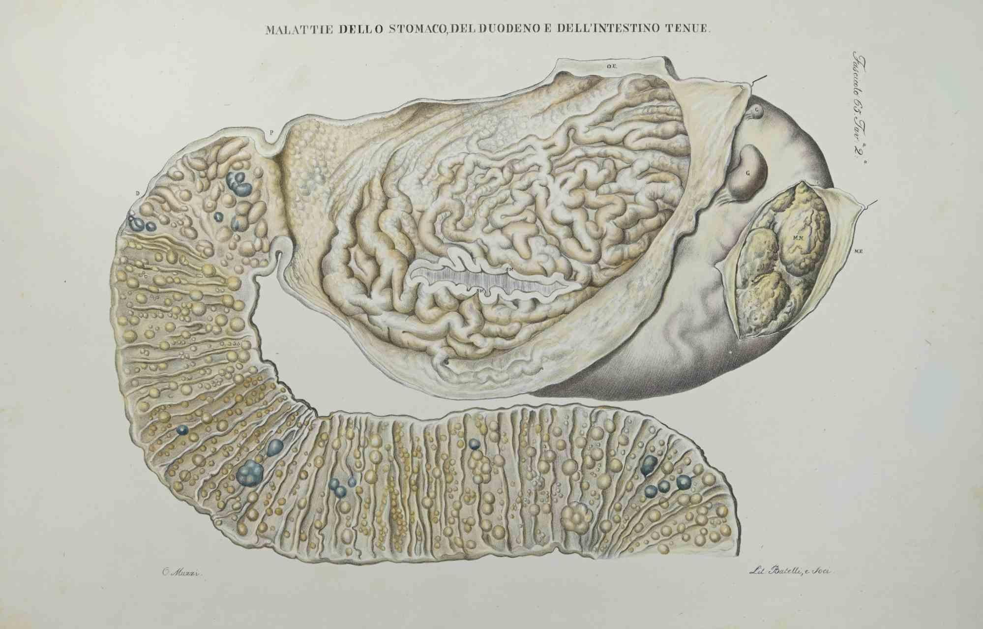Ottavio Muzzi Figurative Print - Diseases of the Stomach, Duodenum and Small Intestine-Lithograph By O.Muzzi-1843