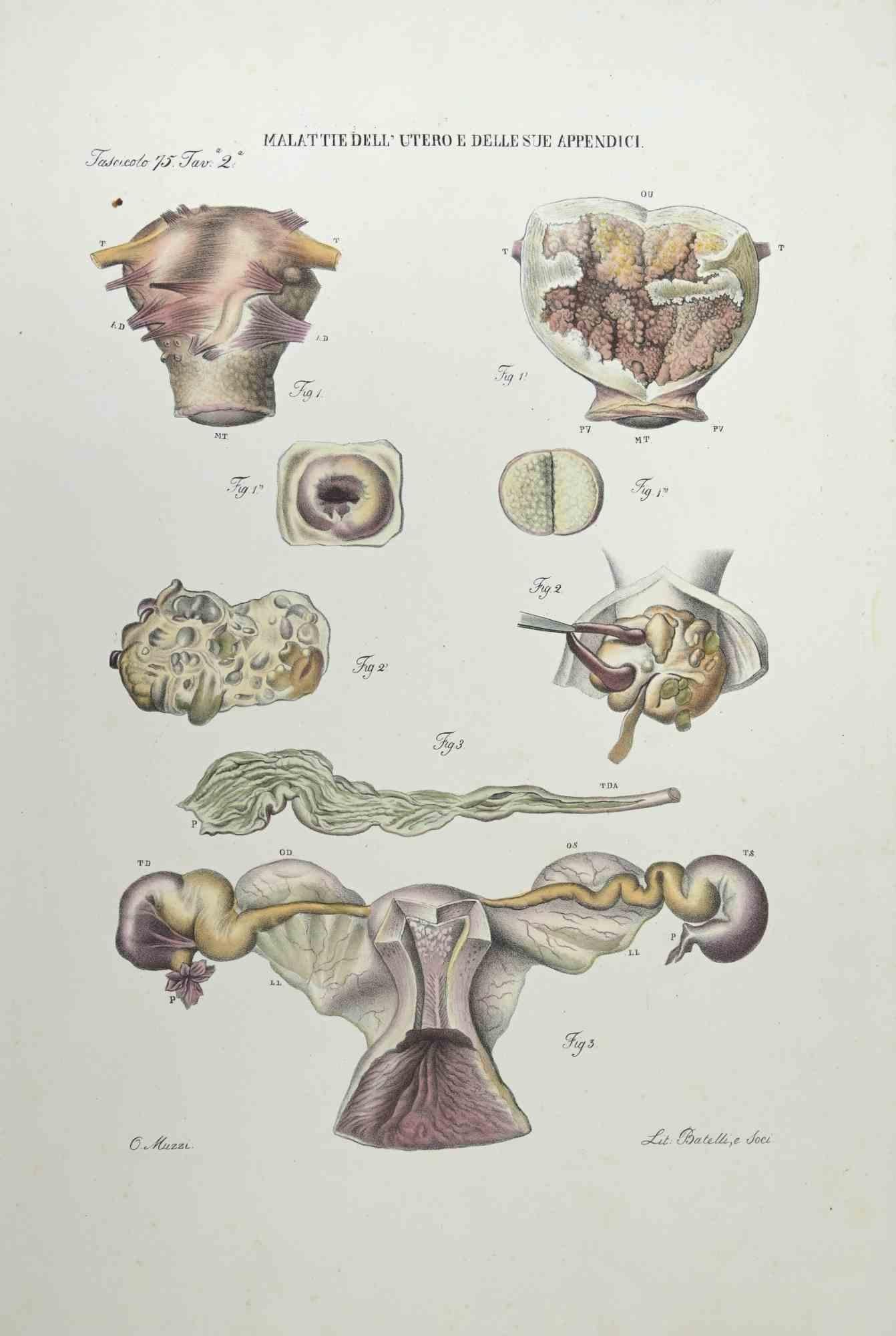 Diseases of the Uterus and its Appendages is a lithograph hand colored by Ottavio Muzzi for the edition of Antoine Chazal,Human Anatomy, Printers Batelli and Ridolfi, realized in 1843.

Signed on plate on the lower left margin.

The artwork belongs