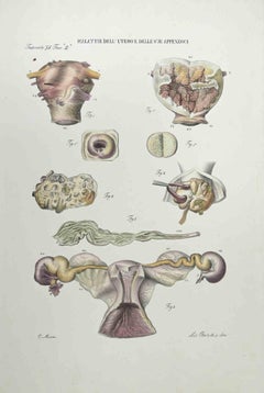 Malattie dell'utero e delle sue appendici - Litografia di Ottavio Muzzi - 1843