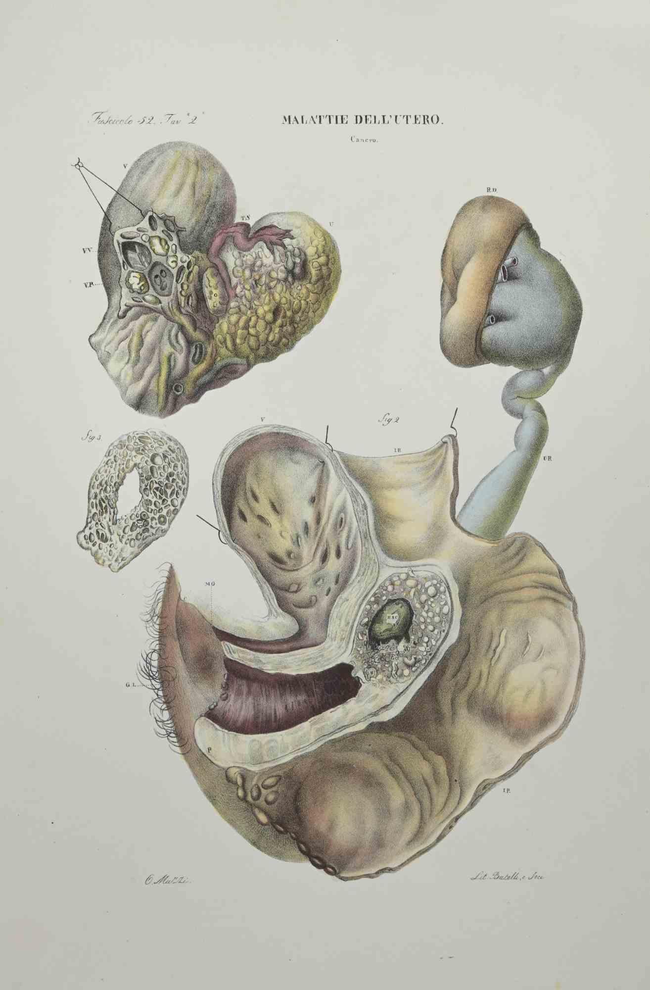 Maladies de l'utérus est une lithographie coloriée à la main par Ottavio Muzzi pour l'édition d'Antoine Chazal, Anatomie humaine, Imprimeurs Batelli et Ridolfi, 1843.

L'ouvrage fait partie de l'Atlante generale della anatomia patologica del corpo