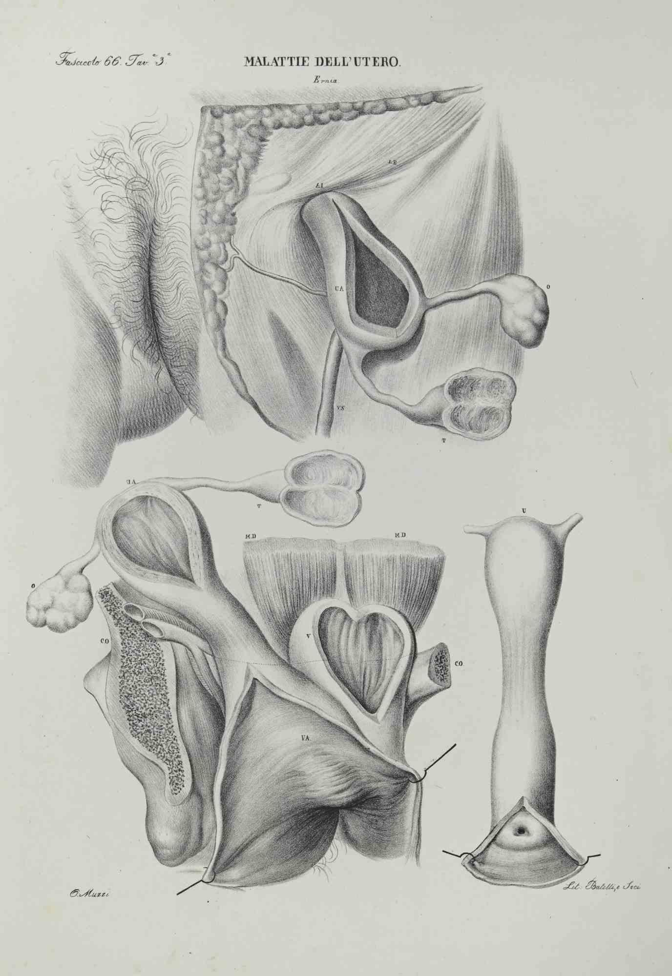 Diseases of the Uterus ist eine handkolorierte Lithographie von Ottavio Muzzi für die Ausgabe von Antoine Chazal, Human Anatomy, Printers Batelli and Ridolfi, 1843.

Das Werk gehört zum Atlante generale della anatomia patologica del corpo umano von