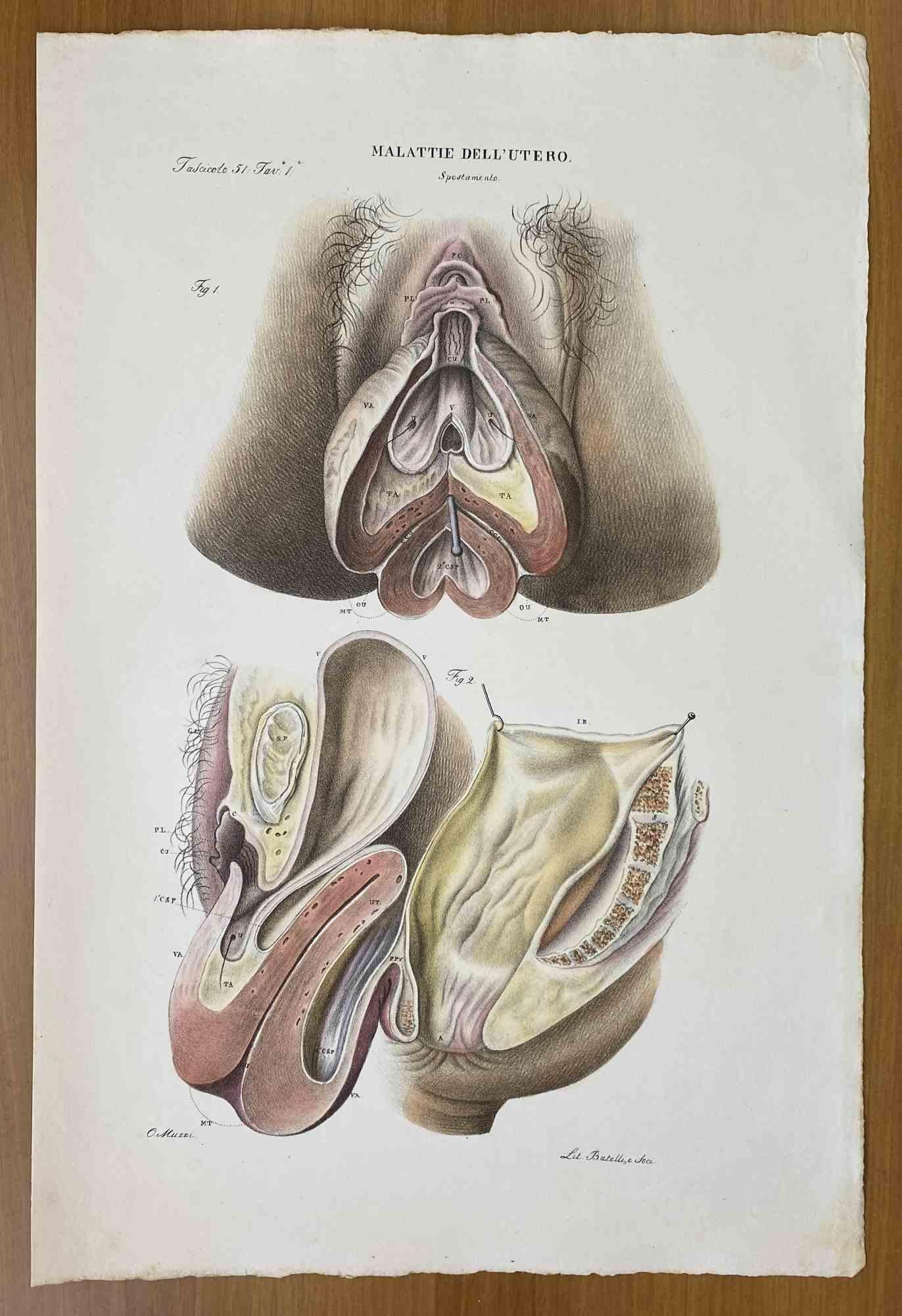 Diseases of the Uterus is a lithograph hand colored by Ottavio Muzzi for the edition of Antoine Chazal, Human Anatomy, Printers Batelli and Ridolfi, 1843.

The work belongs to the Atlante generale della anatomia patologica del corpo umano by Jean