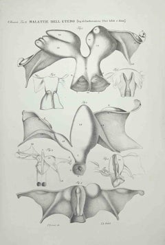 Malattie dell'Utero - Litografia di Ottavio Muzzi - 1843
