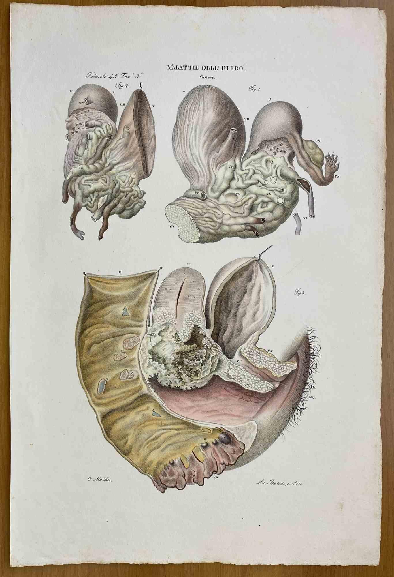  Diseases of Uterus is a lithograph hand colored by Ottavio Muzzi for the edition of Antoine Chazal, Human Anatomy, Printers Batelli and Ridolfi, 1843.

The work belongs to the Atlante generale della anatomia patologica del corpo umano by Jean
