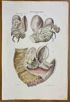 Malattie dell'utero - Litografia di Ottavio Muzzi - 1843