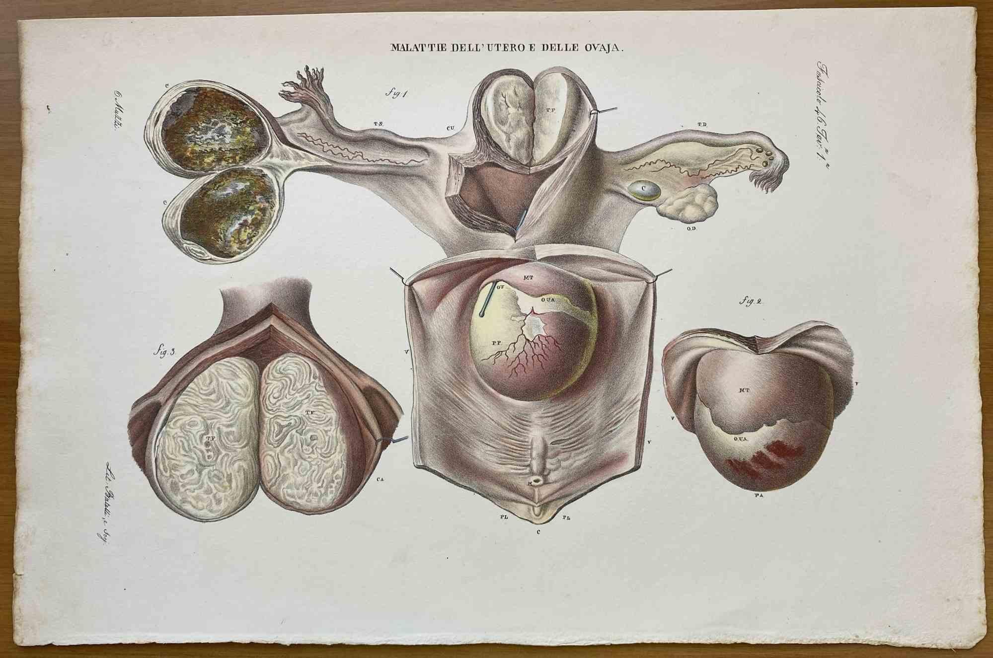  Diseases of Uterus is a lithograph hand colored by Ottavio Muzzi for the edition of Antoine Chazal, Human Anatomy, Printers Batelli and Ridolfi, 1843.

The work belongs to the Atlante generale della anatomia patologica del corpo umano by Jean