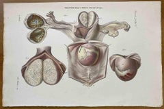 Diseases of Uterus - Lithograph By Ottavio Muzzi - 1843