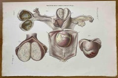 Malattie dell'utero - Litografia di Ottavio Muzzi - 1843